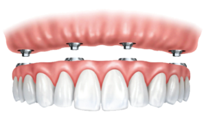 Dentures