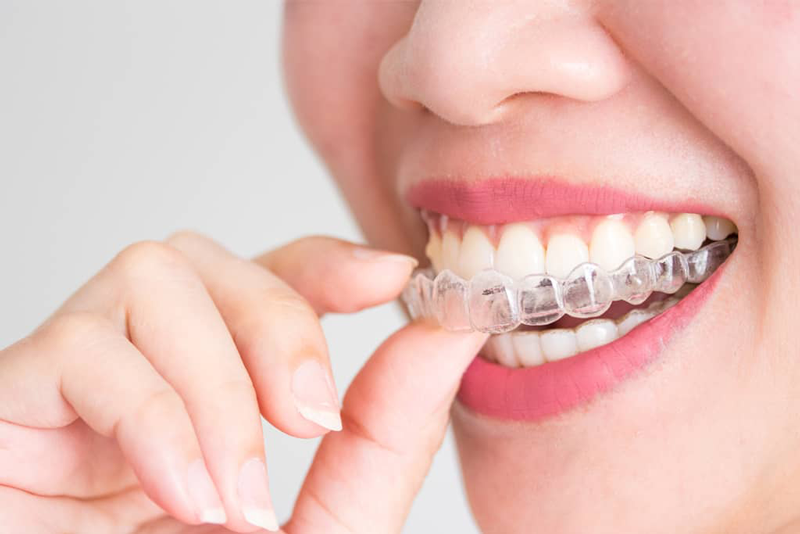 Are invisible braces right for you?